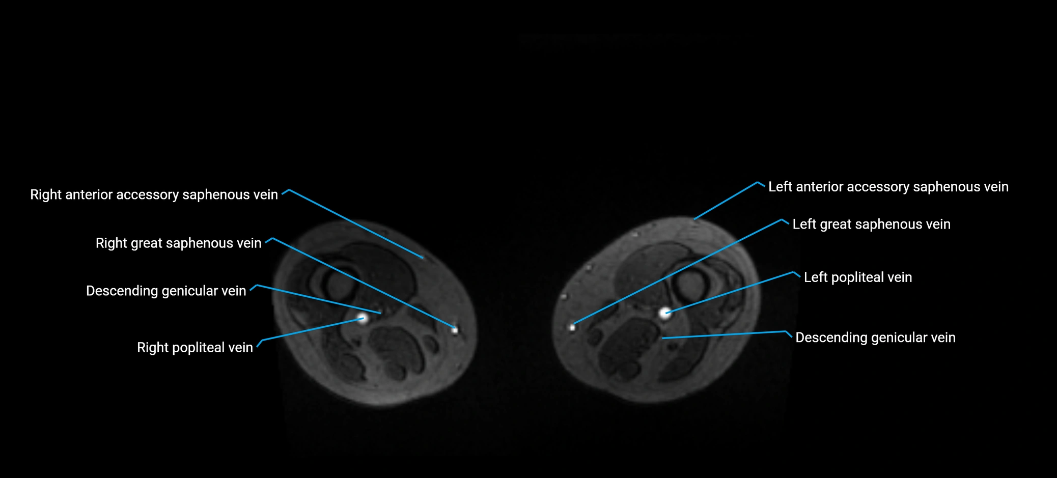 MRV abdomen pelvis & lower limb axial cross sectional anatomy labelled MRI image 322.webp
